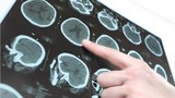 9 triệu chứng cảnh báo "lượng máu cung cấp lên não không đủ"