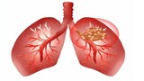 Làm thế nào để xua tan các nốt phổi được phát hiện? 
