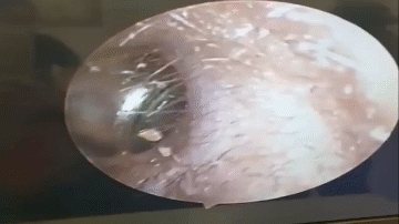 Video: Cận cảnh quá trình gắp cục pin ra khỏi tai bé 8 tuổi