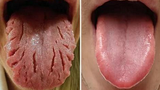 Các dấu hiệu cảnh báo bệnh trên lưỡi