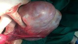 Khiếp đảm khối u nhầy buồng trứng khổng lồ nặng 1,8kg