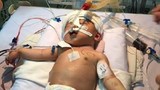 Bé trai 11 ngày tuổi bị đâm xuyên đầu có thể đột tử
