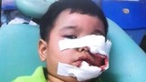 Kinh hoàng bé trai 3 tuổi bị chó Phú Quốc cắn nát mặt