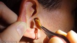 Hãi hùng khối ráy tai khổng lồ trong tai bệnh nhân