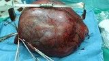 Choáng váng với khối u xơ tử cung “khổng lồ“ nặng 8kg