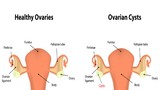 U nang buồng trứng tự triệt tiêu với mẹo dễ thực hiện