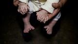 Căn bệnh kỳ lạ khiến cậu bé có 31 ngón tay chân