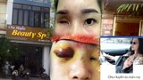 Spa Chu Huyền nói gì khi làm mù mắt cô gái trẻ tiêm filler nâng mũi?