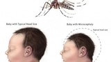 Việt Nam phát hiện ca bệnh do virus Zika, những biến chứng nguy hiểm