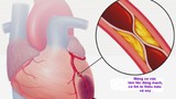 Cụ bà tử vong trên máy bay VNA: Phòng nhồi máu cơ tim thế nào?