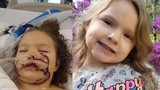Bị chó pit bull tấn công, cô bé 6 tuổi phải khâu 1.000 mũi