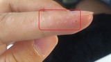 Ngón tay có 6 dấu hiệu này, đi khám ngay gan, phổi và thận