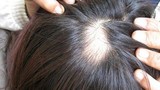6 thói quen xấu khiến rụng tóc, hói đầu