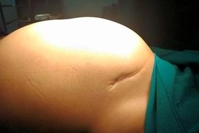 Người phụ nữ tưởng béo bụng không ngờ u buồng trứng gần 13 kg
