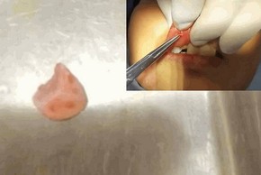 Môi sưng nửa tháng, đi khám bác sĩ phát hiện chuyện kinh dị 