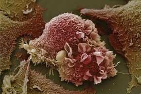 Sự phá huỷ tàn khốc của tế bào ung thư