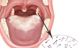 Cần làm gì khi tiếp xúc gần với bệnh nhân mắc bạch hầu?