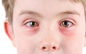 4 bệnh mắt thường gặp vào mùa mưa