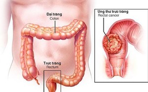 Đi ngoài liên tục, sút cân… đi khám phát hiện ung thư trực tràng