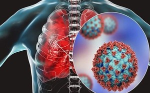 Virus HMPV gây viêm phổi không có tác nhân bất thường