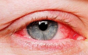 Làm gì khi đi chơi Tết bất ngờ bị đau mắt đỏ? 
