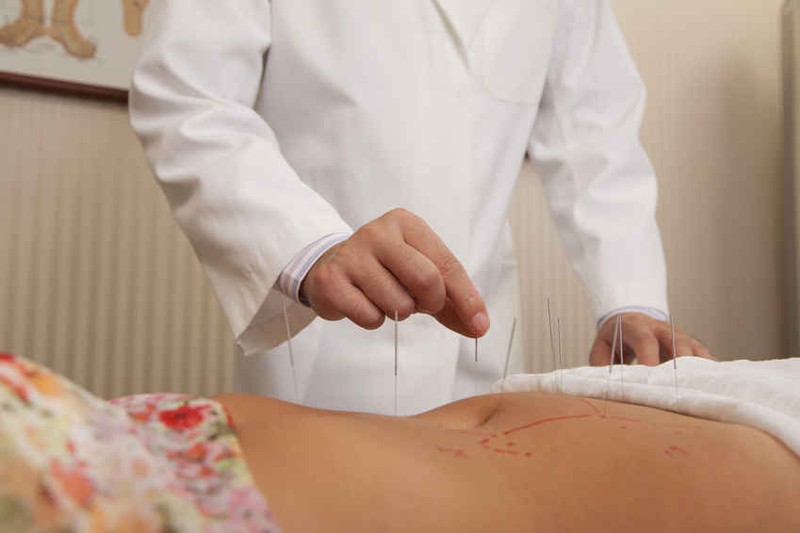 Phương pháp châm cứu có tác dụng làm giảm triệu chứng u xơ tử cung