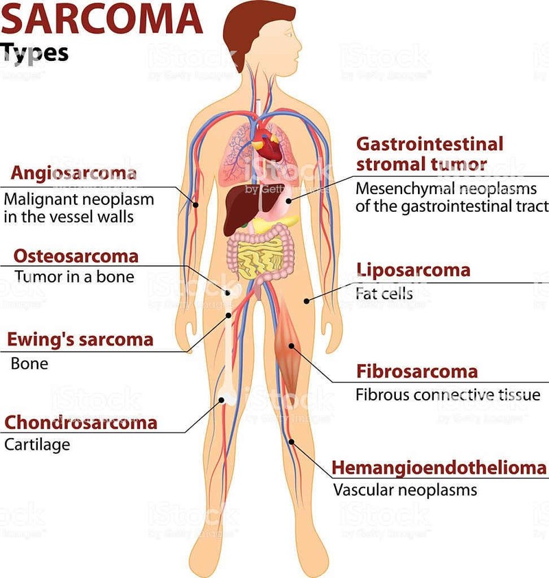 Ung thư Sarcoma