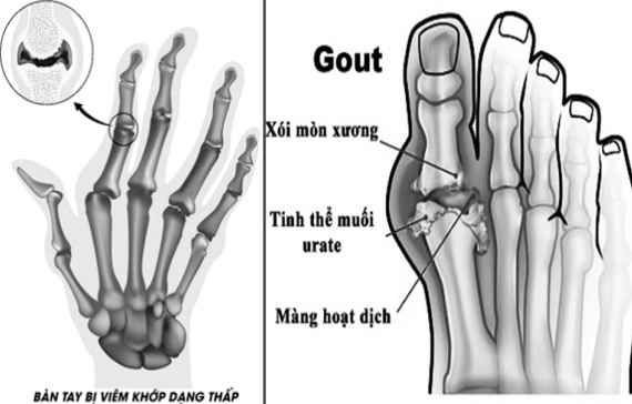 Viêm khớp dạng thấp và bệnh gout dễ mắc trong mùa đông.