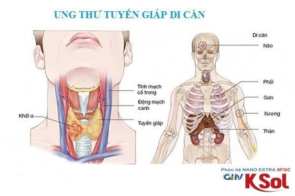 ung-thu-tuyen-giap-di-can-hach-co.jpg