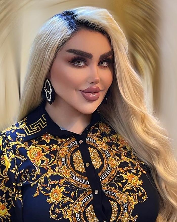 Phau thuat 43 lan vi muon giong bup be Barbie va ket dang-Hinh-2