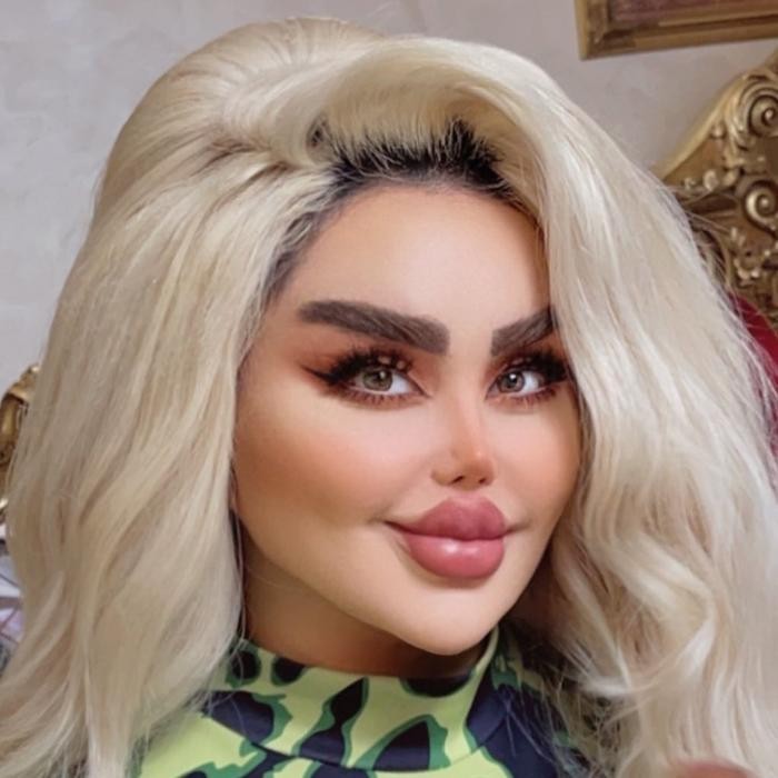 Phau thuat 43 lan vi muon giong bup be Barbie va ket dang