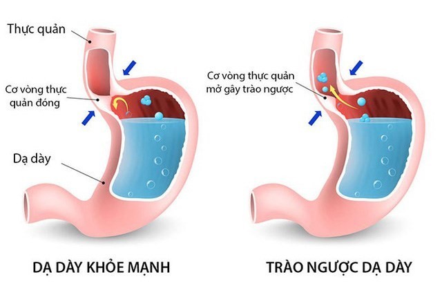 Cach tranh trao nguoc da day, thuc quan trong va sau Tet