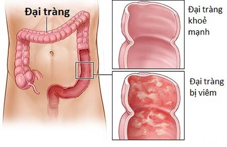 Ai de mac ung thu truc trang nhu nhạc sĩ Tran Lap?-Hinh-2