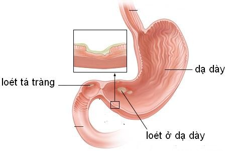 Uong nuoc chanh mat ong qua nhieu nguy hiem the nao?-Hinh-3