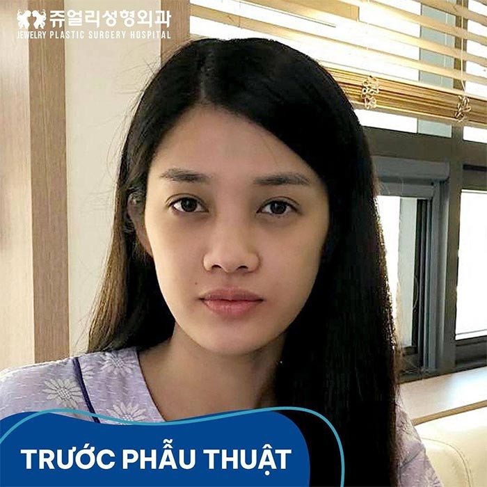 Trinh My Duyen “lot xac” sau phau thuat tham my