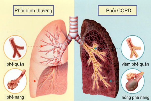 Phong chong benh tat tranh benh nhe sinh benh nang-Hinh-8