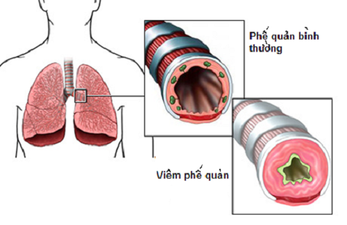 Mon chao tri viem khi quan, ho lau ngay tot hon thuoc