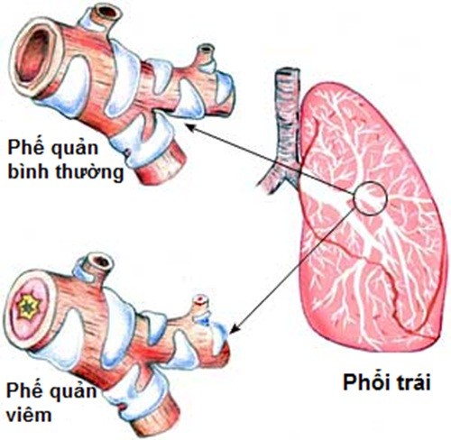 Meo phan biet hen phe quan va tac nghen phoi man tinh