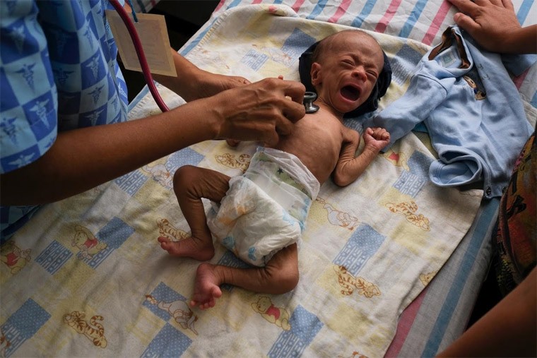 Hình ảnh khủng khiếp về trẻ em Venezuela suy dinh dưỡng