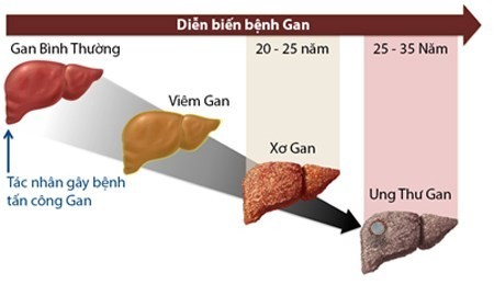 Rùng mình ảnh gan xo hóa lõ chõ nhu tỏ ong vì ruọu-Hinh-2