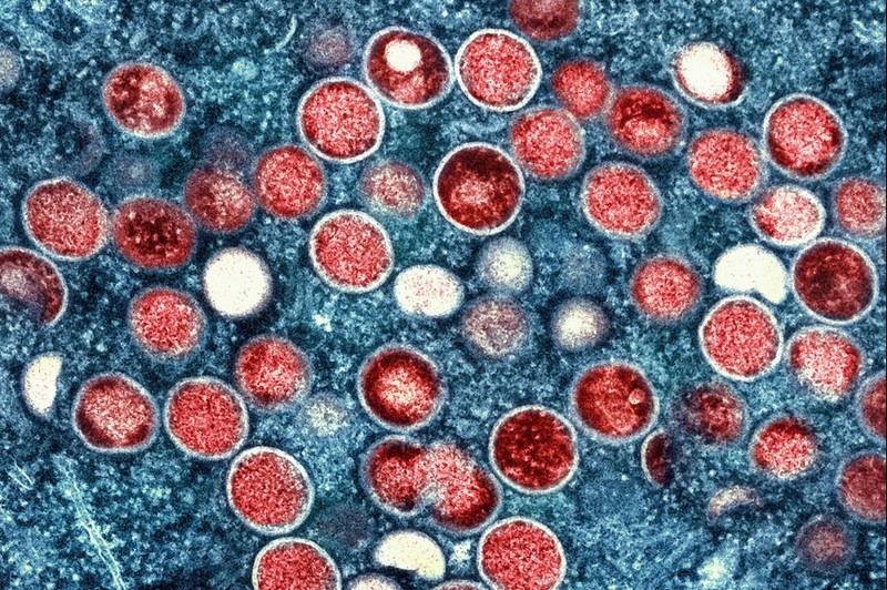 Nguoi nhiem virus Mpox gay benh dau mua khi nen di xet nghiem HIV