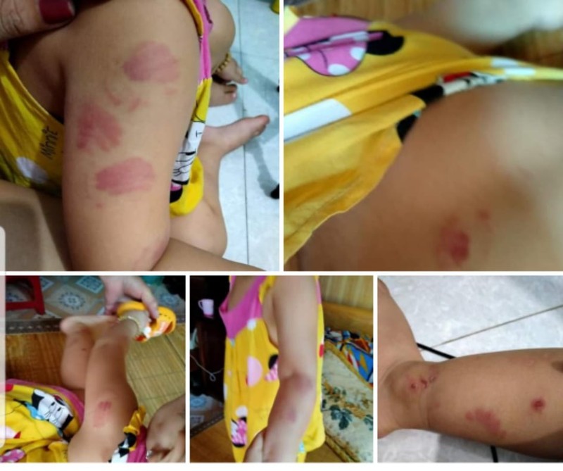 Thai Binh: Tre mam non xa An Vinh nghi bi can tay do nguoi khi den lop