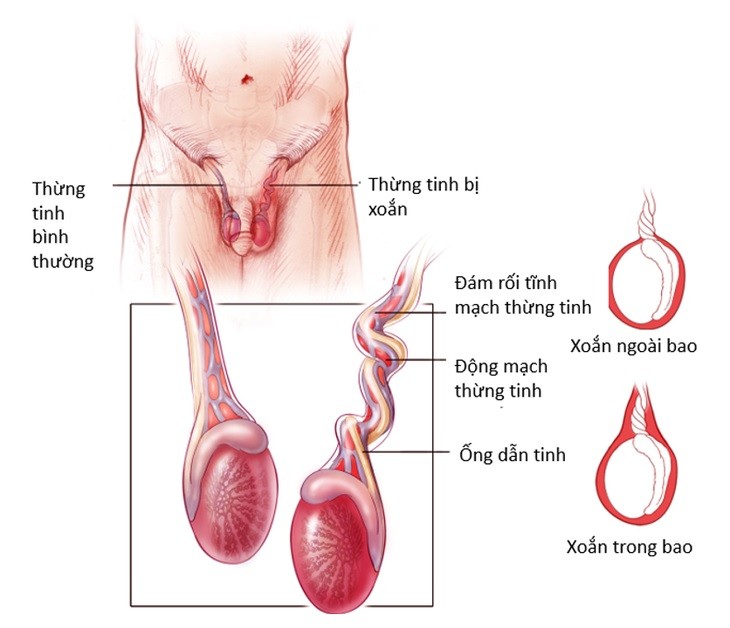 Thanh nien 16 tuoi bi xoan tinh hoan hoai tu