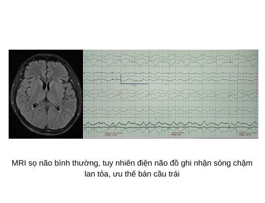 Dieu tri thanh cong ca viem nao tu mien hiem gap