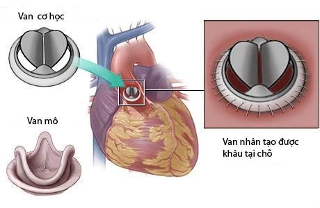 Dung tieu soi huyet cuu benh nhan ket van tim nhan tao