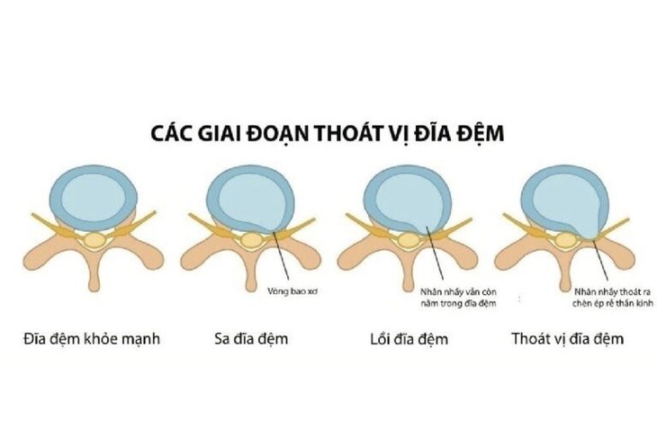 Chuyen gia mach dau hieu benh thoai hoa dia dem cot song that lung-Hinh-3