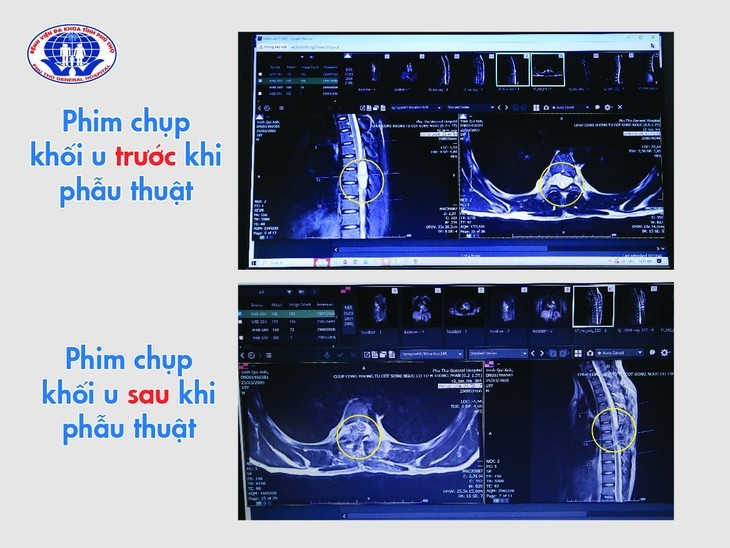 Chang trai 19 tuoi liet 2 chan vi u tuy