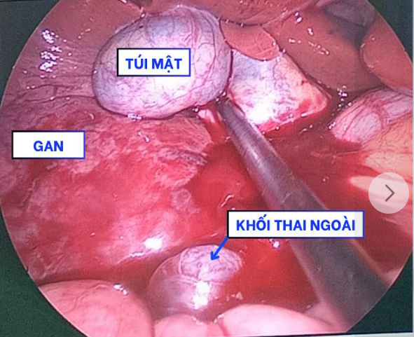 Nguoi phu nu 27 tuoi chua ngoai tu cung, thai lam to o gan-Hinh-2