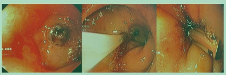 Be trai 13 tuoi oi ra mau vi nhiem khuan Helicobacter pylori