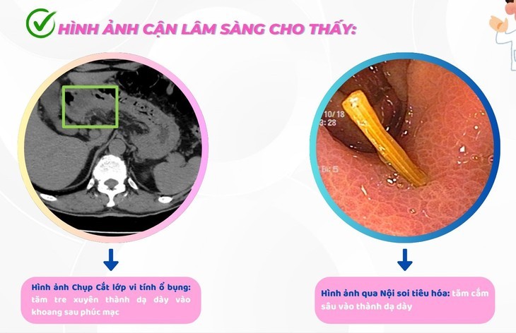 Nhieu truong hop nuot phai tam tre nguy hiem